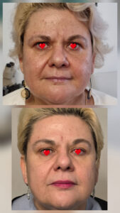 Peeling, Biorivitalizzazione e filler labbra