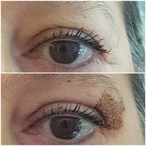 Blefaroplastica mediante plasma
