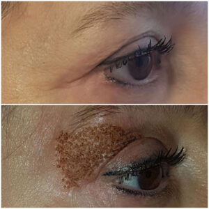 Blefaroplastica mediante plasma