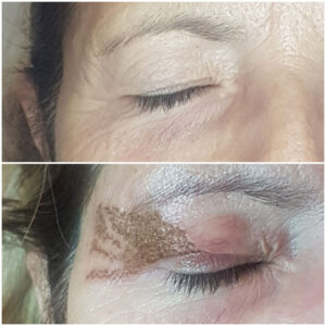 Blefaroplastica mediante plasma