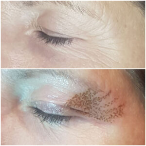 Blefaroplastica mediante plasma