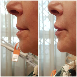 Filler labbra