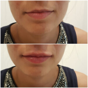 Filler labbra
