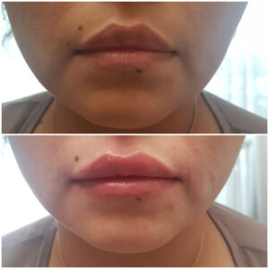 Filler labbra