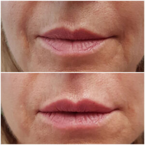 Filler labbra
