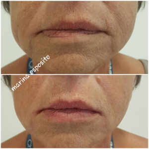 Filler labbra