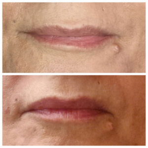 Filler labbra