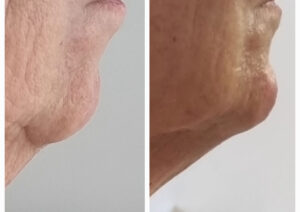 Riempimento del mento filler